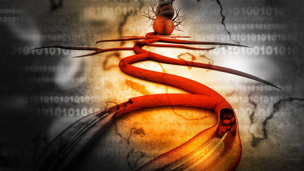 Stent: Cara Kerja, Prosedur, dan Risiko yang Harus Diketahui