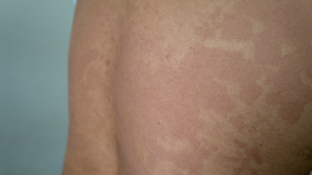 Panu Bukan Sekadar Masalah Kulit: Ini Dampak Psikologisnya