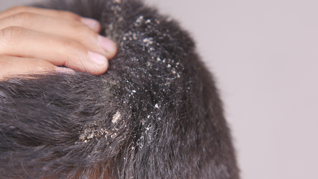 Perbedaan Ketombe Kering dan Basah: Cara Menangani yang Tepat