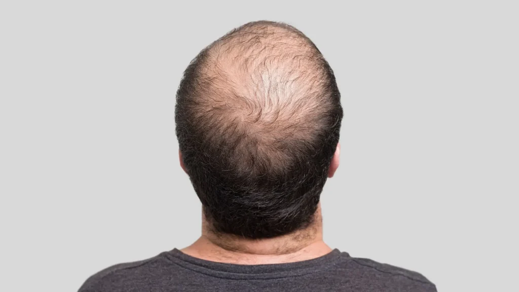 Kebotakan pada Pria dan Wanita: Apa Bedanya?